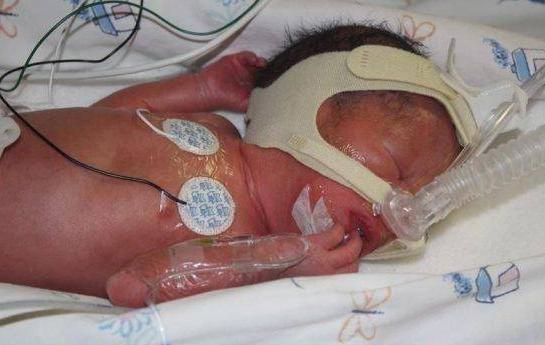 5分钟剖腹产3胞胎变5胞胎，南非妇女一下生5个孩子，丈夫懵了