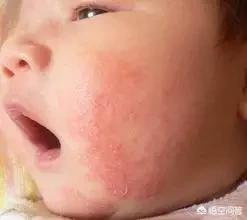 新生儿脸部湿疹怎么办？可以抹什么来消除？