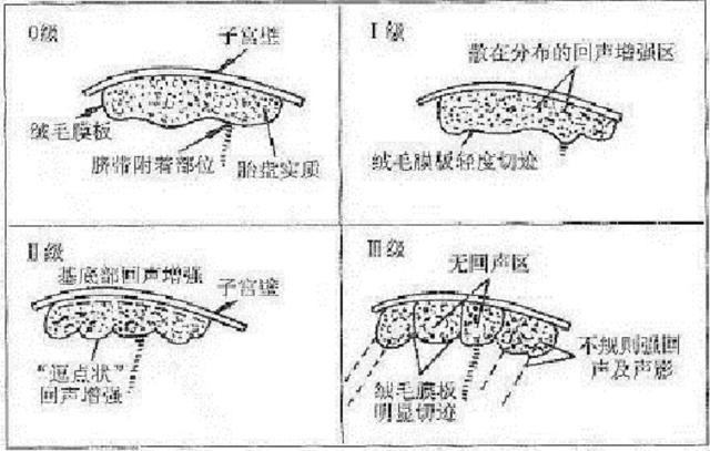 胎盘到达这个级别，孕妈可能与顺产无缘了，四类孕妈要当心