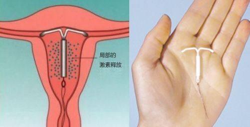 了解什么是“上环”后，我整个人都不太好了