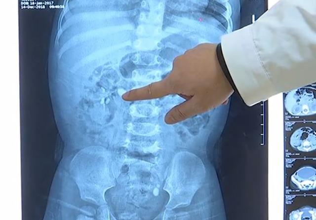 爸妈看了眼1岁女儿的小便，魂都吓飞了！竟是因为给她吃了……