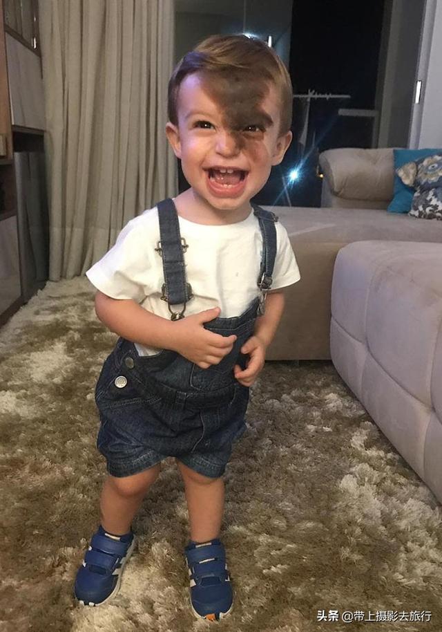 儿子一出生脸上就有大片胎记，妈妈为孩子毁容一起面对别人眼光！