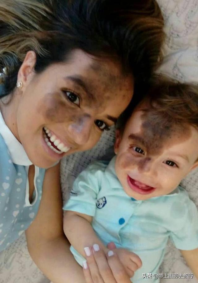 儿子一出生脸上就有大片胎记，妈妈为孩子毁容一起面对别人眼光！