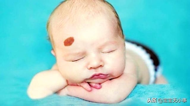 胎儿出生就有胎记?和孕妇的这2种行为有关,有的快改