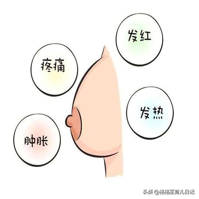 喂母乳时遇到结奶堵奶怎么办？过来人帮你支招，早知道，早解决