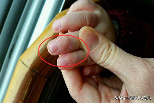 孩子手上长“倒刺”？原因是这些家长要重视，吃它恢复快！