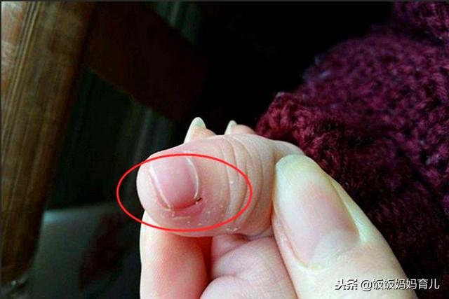 孩子手上长“倒刺”？原因是这些家长要重视，吃它恢复快！