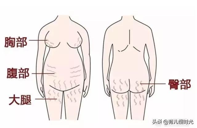 按摩涂油就能避免妊娠纹？妊娠纹出现的真相大揭秘
