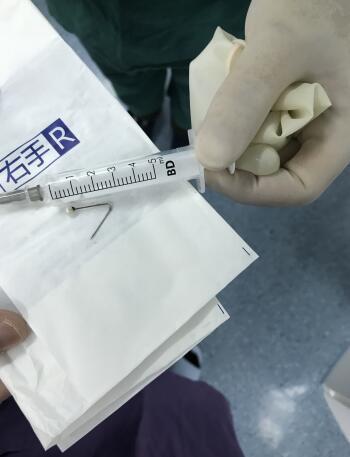 9个月男童不慎吞入4厘米长头针 医生巧用纤支镜取出避免开胸