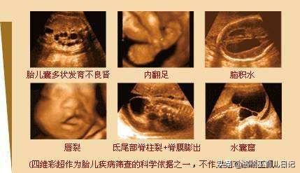 孕妇四维要不要做？对宝宝好吗？过来人给你四点建议，早知道好些