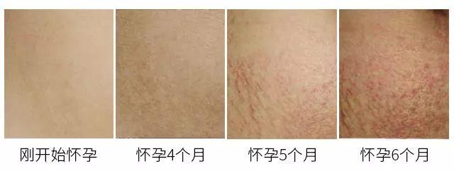 生过宝宝留下花纹咋办呢？