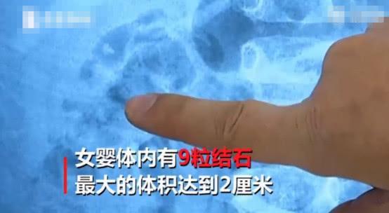 因为父母担心孩子身高输在起跑线疯狂补钙，1岁女婴双肾长满结石