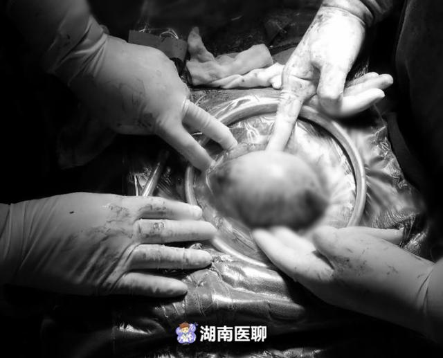心太大！胎盘早剥母子命悬一线，产妇称：从没做过产检