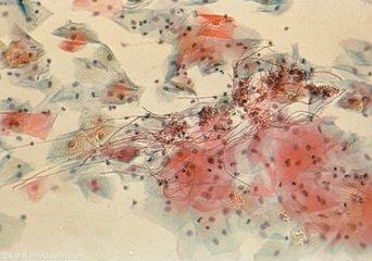 有关宝宝鹅口疮的基本知识