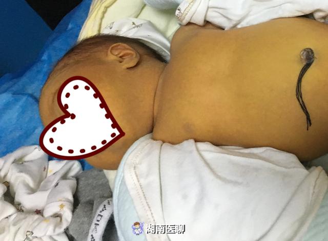 父母擅自喂药致病情加重！“茵栀黄口服液”绝不是治疗黄疸万能药