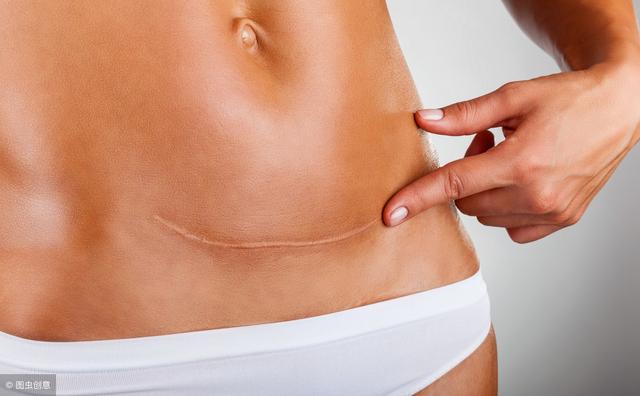 同样是剖宫产，为什么有人疤痕那么明显？术后要如何护理？