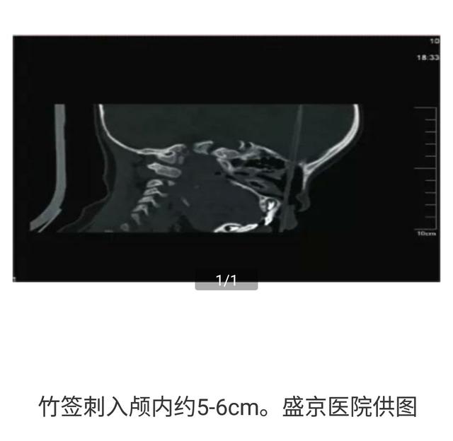 类似事件不止1例！小儿外科、急诊科联合警示：远离小儿意外伤！