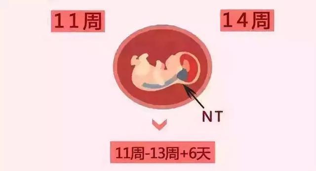 关于NT检查，孕妈想问的问题，答案都在这儿了~