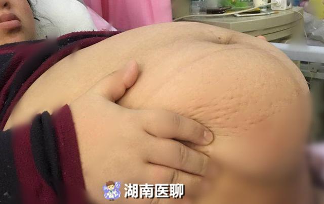 孕妇重达249斤！二孩妈妈孕期过度进补，患上高血压、糖尿病