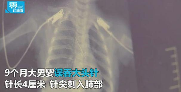 婴儿误吞4厘米长针 针尖刺入肺部险开胸！
