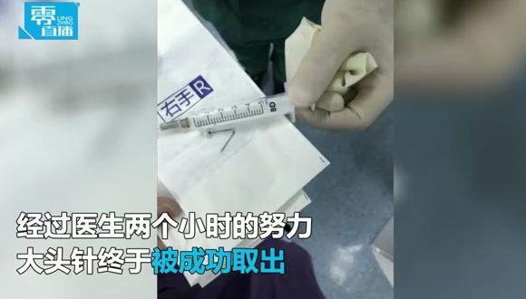婴儿误吞4厘米长针 针尖刺入肺部险开胸！