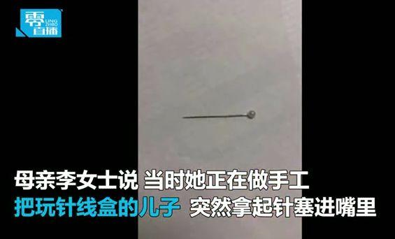 婴儿误吞4厘米长针 针尖刺入肺部险开胸！