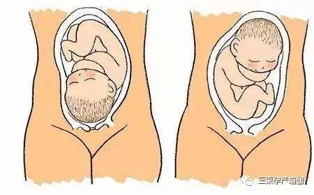 什么是胎儿臀位，胎位臀位能纠正和顺产吗？