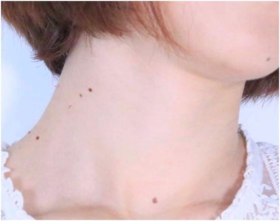 生完孩子，脖子丝状疣疯长？这3碗汤厉害，去疣又排毒