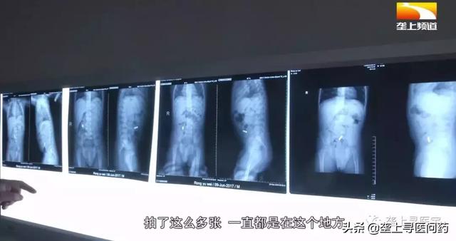 1岁半宝宝误服3颗磁珠险丧命，这种“致命玩具”看看你家有吗
