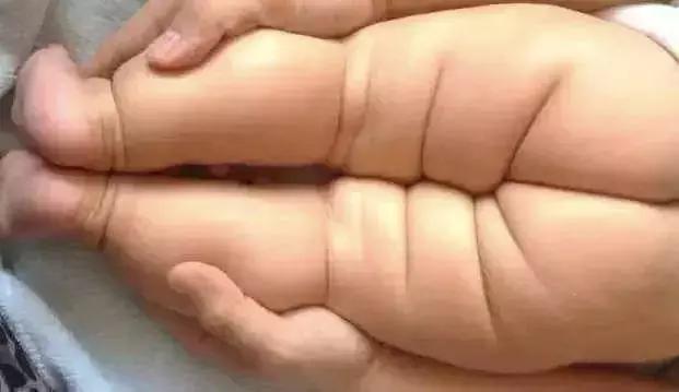 注意！宝宝腿纹臀纹不对称，可不能忽略！