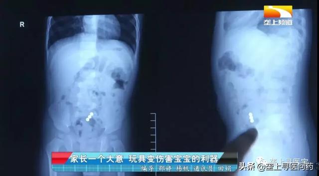 1岁半宝宝误服3颗磁珠险丧命，这种“致命玩具”看看你家有吗