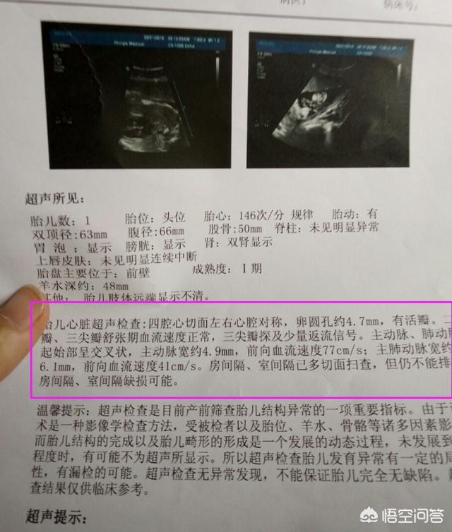 胎儿心脏彩超必须要做吗？为什么？
