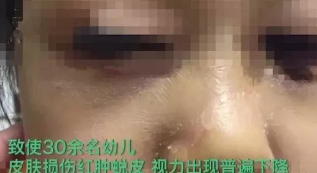 悲剧！老师误开紫光灯造成30余儿童眼睛灼伤！