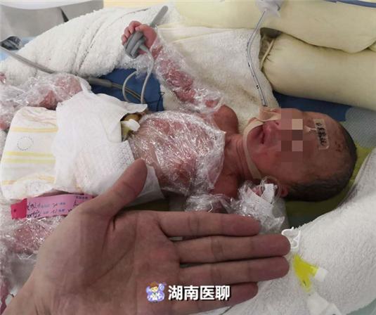出生只有巴掌大？孕妈29周迎来早产儿，“袖珍宝宝”体重不足两斤