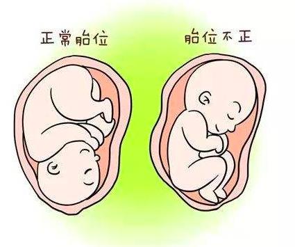 孕晚期时宝宝臀位朝下怎么办？