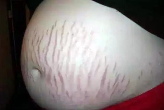 妊娠纹不美观还影响心情，做好4件事，有效预防，爱美孕妈别错过