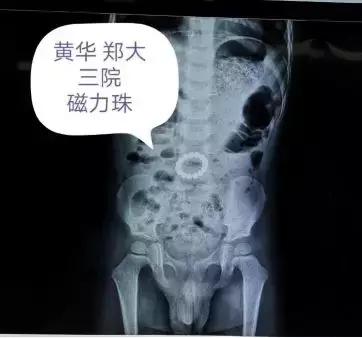 15颗磁力珠被2岁娃误食！医生腹腔镜下悉数取出胃肠内全部磁力珠