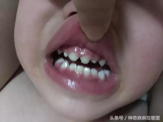 宝宝乳牙磕掉了小半颗，要补吗？