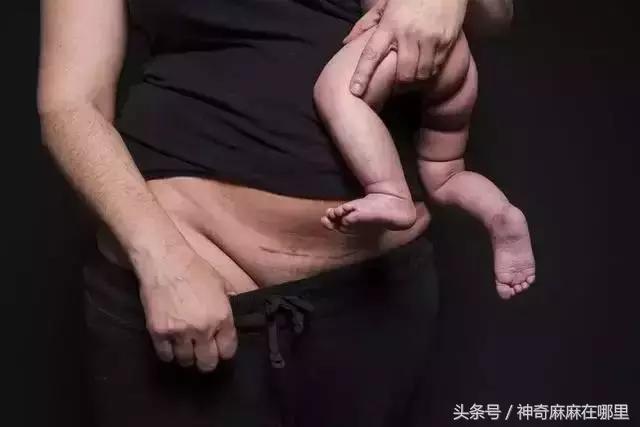 剖腹产刀疤痒痒的？小心它正在长大！