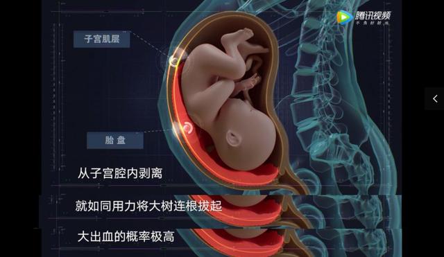 赌命生子：你愿意用生命，来换孩子的出生吗？