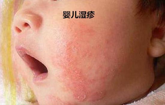 湿疹和热疹的区别 妈妈你别再傻傻分不清了