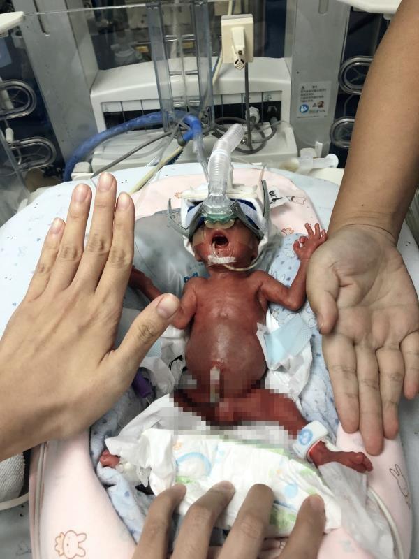 最轻早产儿仅545克，袋鼠式护理让超级迷宝“一斤妹”顺利回家