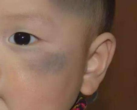 孕期少做4件事,容易形成胎记,影响宝宝颜值,孕妈要注意