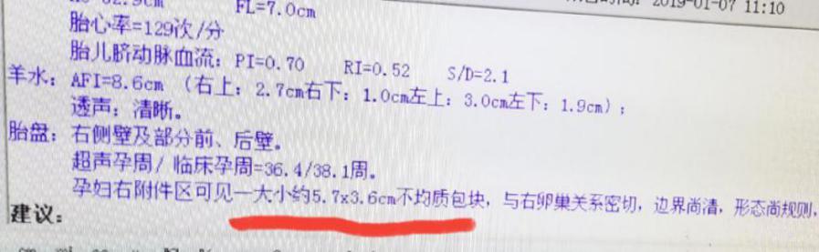 孕晚期突发腹痛：当心卵巢肿瘤扭转