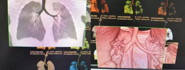 宝宝“肺炎”拖了2个月，医生找出原因后，家长“蒙圈”了！