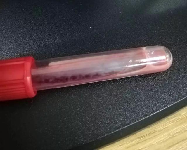 热点丨医生震惊！怀胎32周孕妇突发腹疼，抽血检查发现有半管都是油脂……孕期这些东西别乱吃