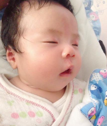 一岁女孩的脸像“充了气”，起因是爸妈常用这种药治“红屁屁”