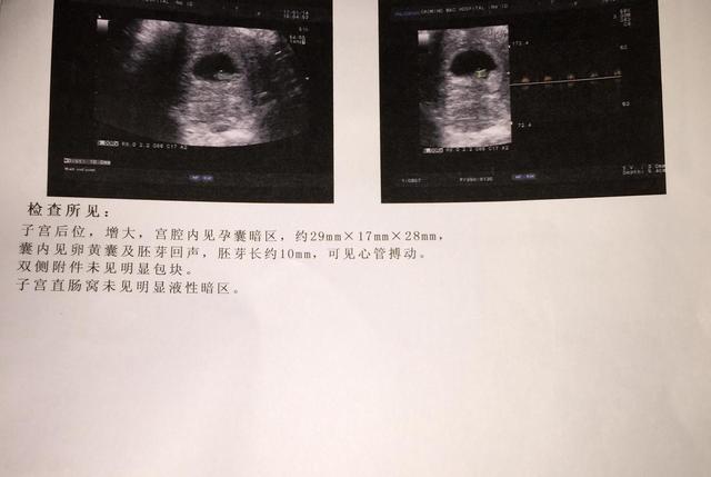 B超单上孕囊数据暗藏玄机，与胎儿性别无关，与这几点有关