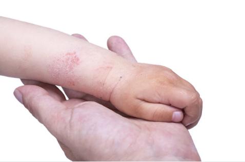 孩子湿疹总不好？儿科医生教我4个方法，不花冤枉钱，湿疹拜拜