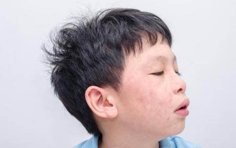 孩子湿疹总不好？儿科医生教我4个方法，不花冤枉钱，湿疹拜拜